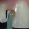 SISTEMA EASY PARA CARIES KIT TES25