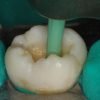 SISTEMA EASY PARA CARIES KIT TES25